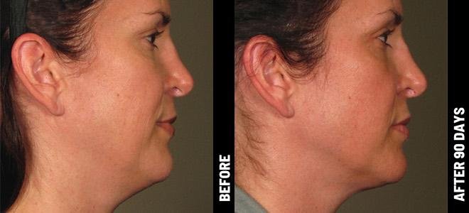 Before and after Procell — jawline, 90 days