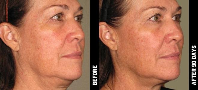 Before and after Procell — skin texture, 90 days